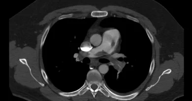 blood clot diagnosis with CT