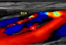 Carotid Artery Dissection Ultrasound