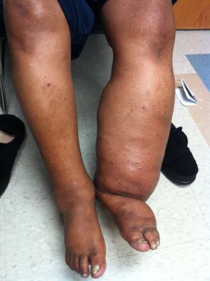 one swollen leg from lymphedema