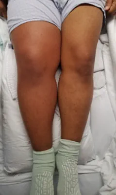 one swollen leg from DVT