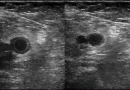 Blood clot diagnosis with ultrasound