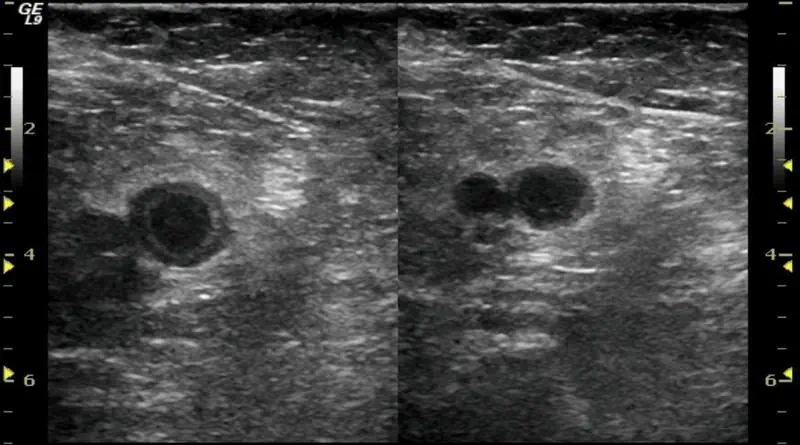 Blood clot diagnosis with ultrasound
