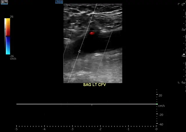 acute or chronic clot on ultrasound